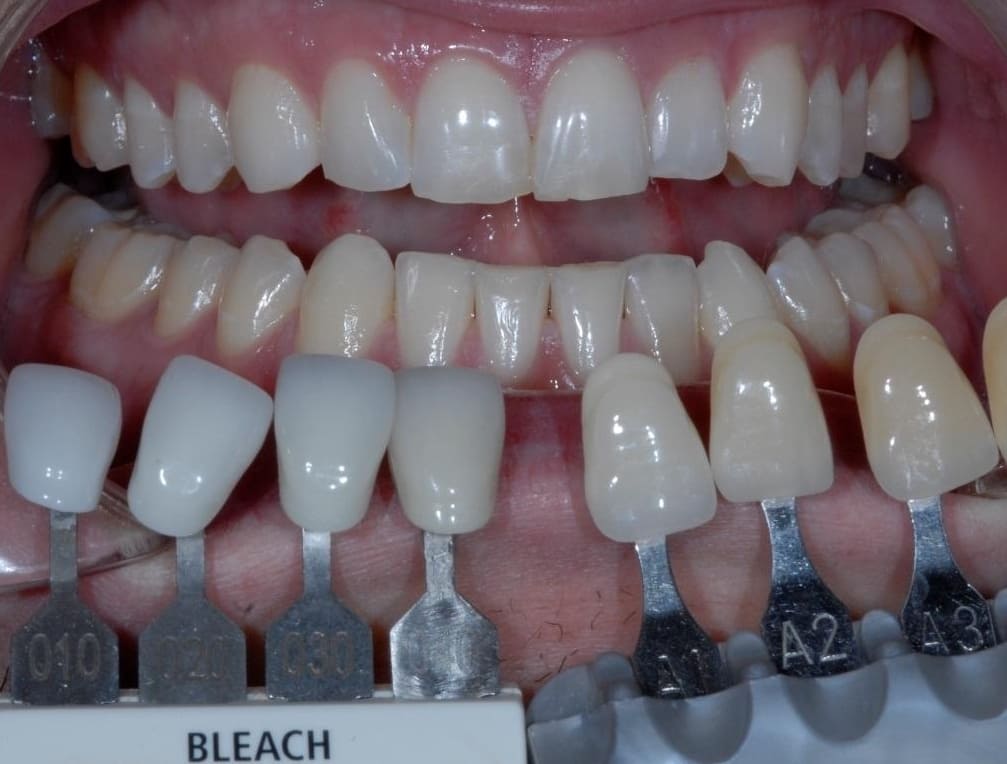 Порівняння зубів з еталонними зразками.